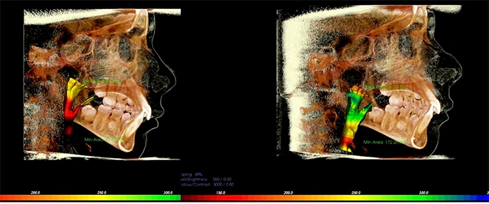 Pediatric Dentist Campbell CA 3D Imaging of Child With Sleep Apnea 3D Imaging of Child With Sleep Apnea