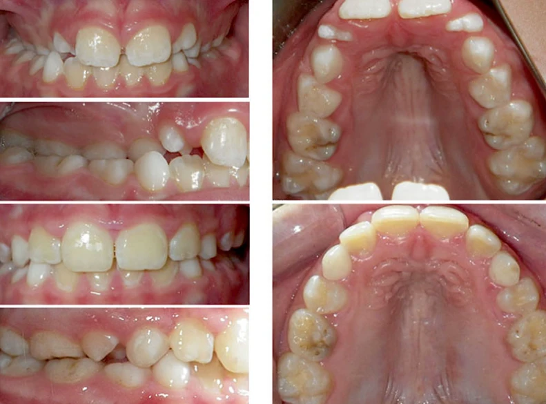 Pediatric Dentist Campbell CA Child Before and After Orthodontic Treatment Childs Mouth Before and After Orthodontic Treatment