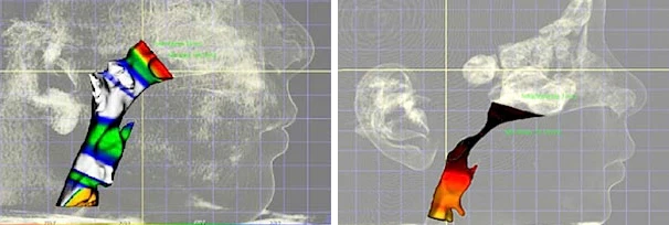 Pediatric Dentist Los Gatos CA 3D Imaging of Child With Sleep Apnea 3D Imaging of Child's Trachea With Sleep Apnea